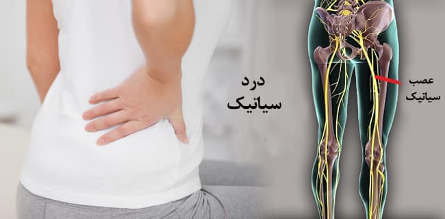 روش های درمانی درد سیاتیک