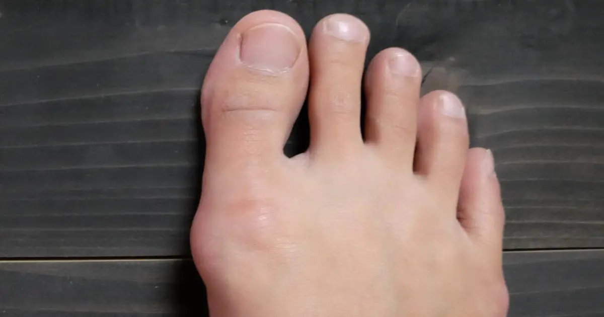 انحراف شست پا