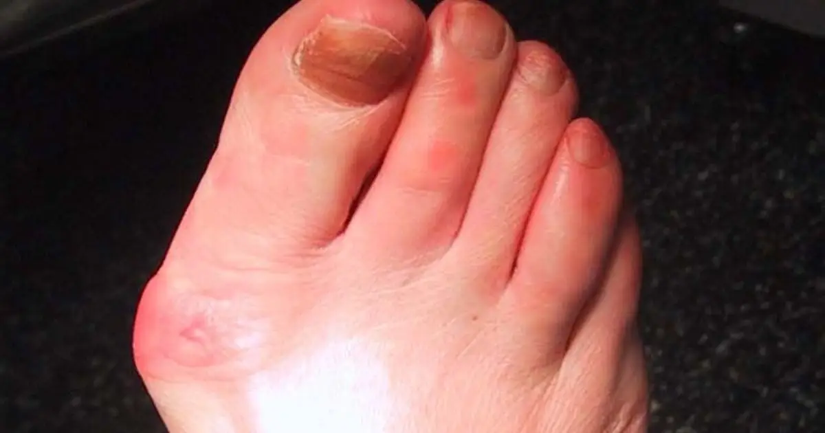 انحراف شست پا