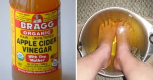 سرکه درمان فوری خارپاشنه